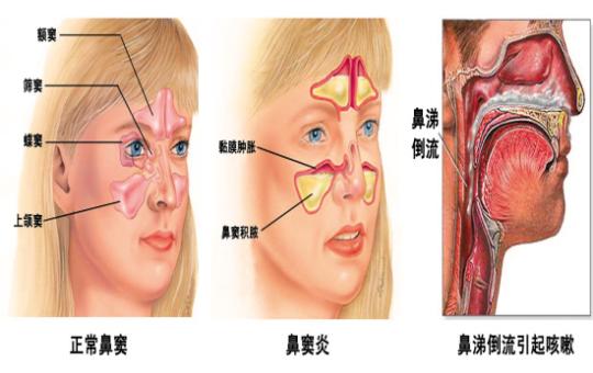 之后见效好了一点,鼻子老堵,决定学习洗鼻法 经过一段时间的摸索与